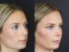 Rhinoplasty case #8344 slider thumbnail