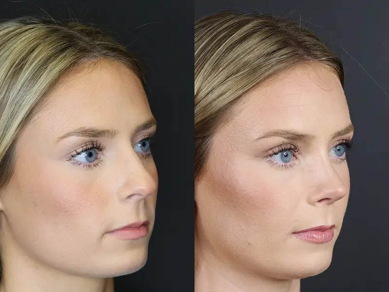 Rhinoplasty case #8344