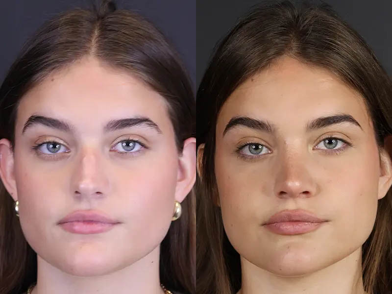 Rhinoplasty case #8366