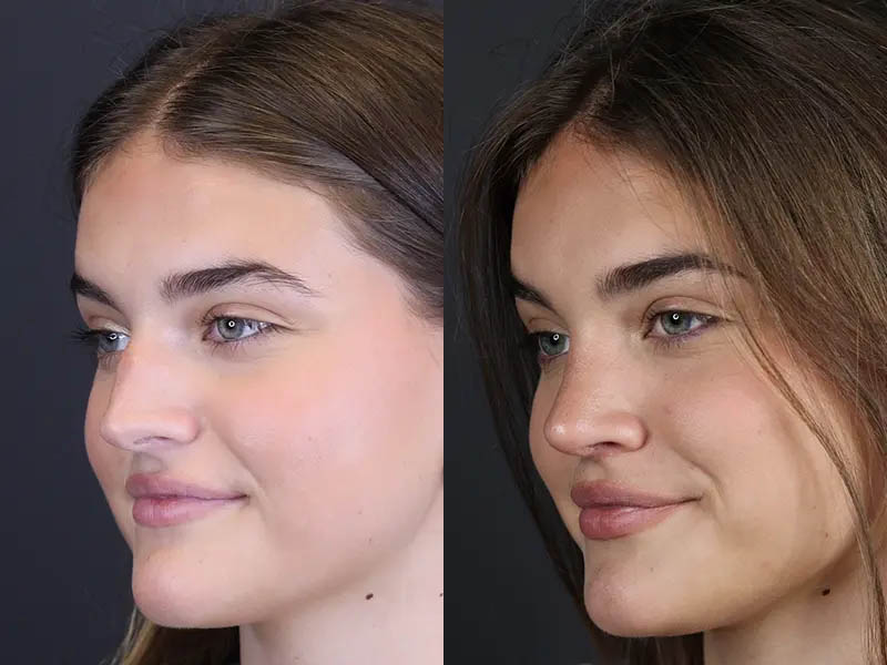 Rhinoplasty case #8366