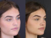 Rhinoplasty case #8366 slider thumbnail