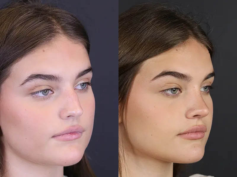 Rhinoplasty case #8366