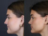 Rhinoplasty case #8366 slider thumbnail