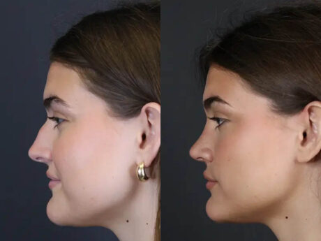 Rhinoplasty case #8366