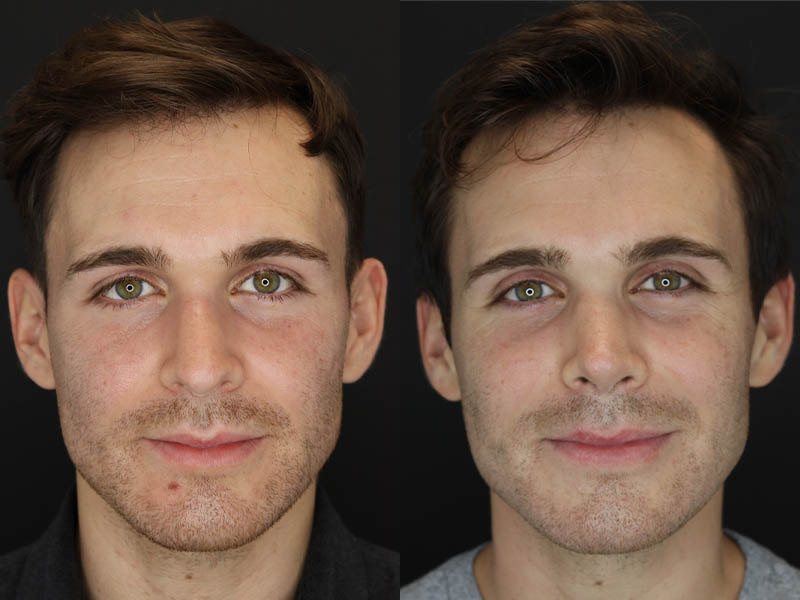 Rhinoplasty case #8381