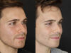 Rhinoplasty case #8381 slider thumbnail