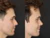 Rhinoplasty case #8381 slider thumbnail
