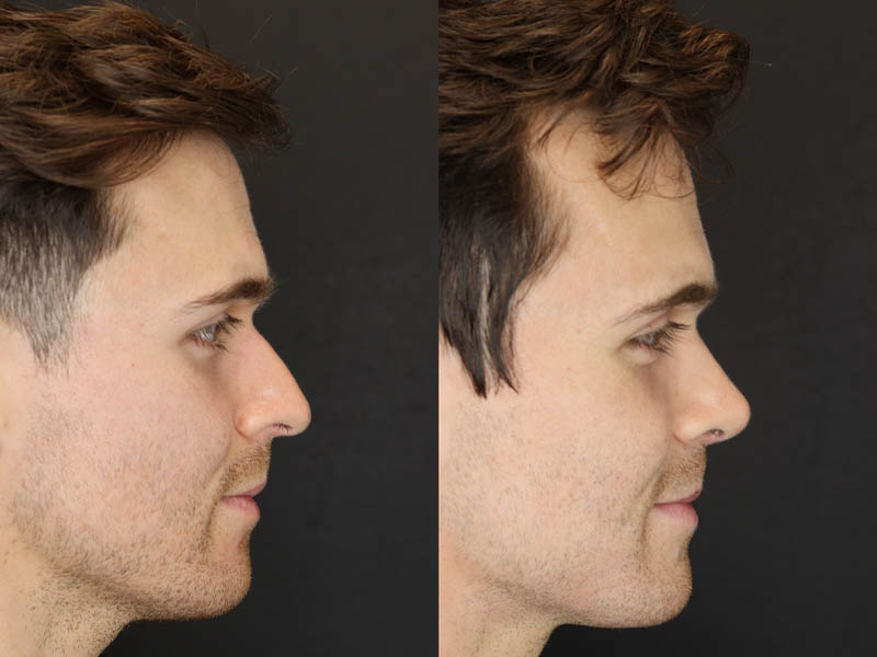 Rhinoplasty case #8381