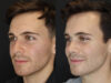 Rhinoplasty case #8381 slider thumbnail