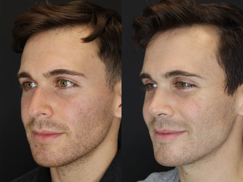 Rhinoplasty case #8381