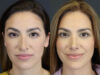 Rhinoplasty case #8392 slider thumbnail