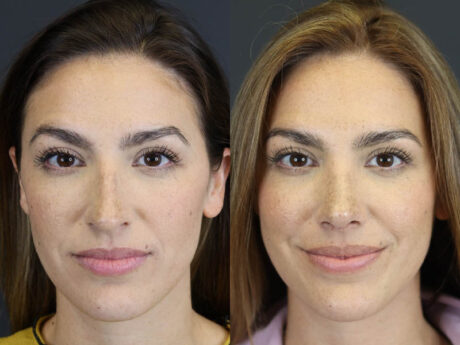 Rhinoplasty case #8392
