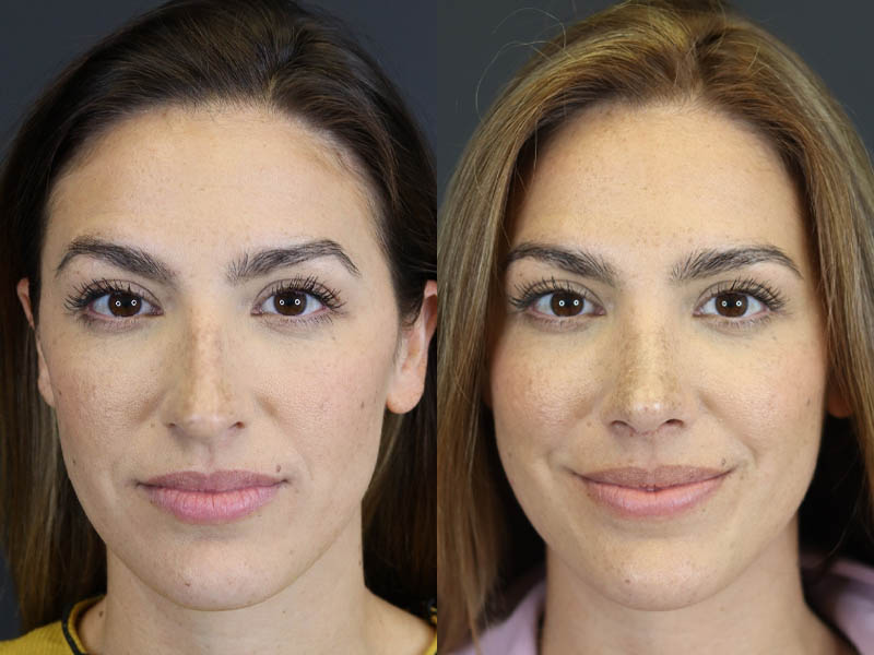 Rhinoplasty case #8392