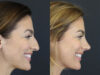 Rhinoplasty case #8392 slider thumbnail