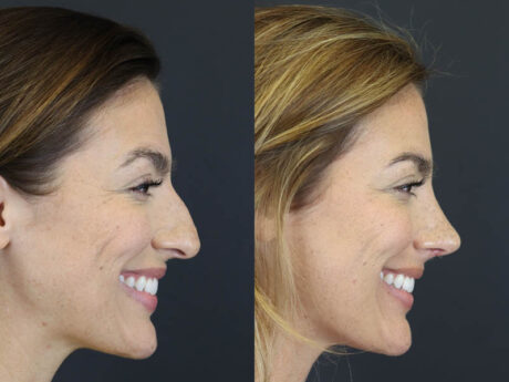 Rhinoplasty case #8392
