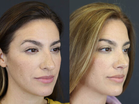 Rhinoplasty case #8392