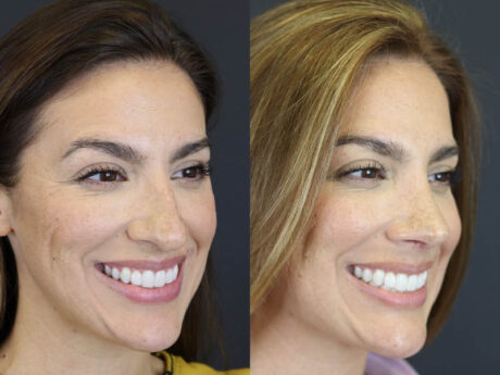 Rhinoplasty case #8392