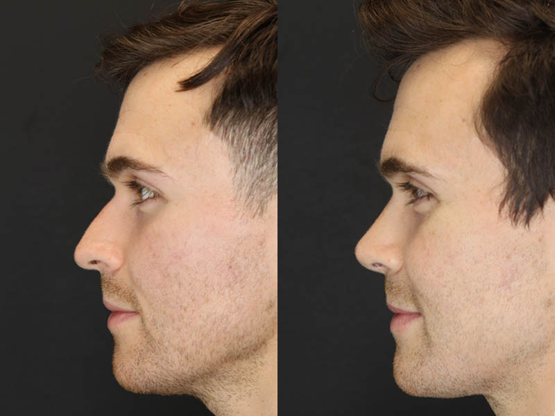 Rhinoplasty case #8381