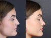 Rhinoplasty case #8366 slider thumbnail