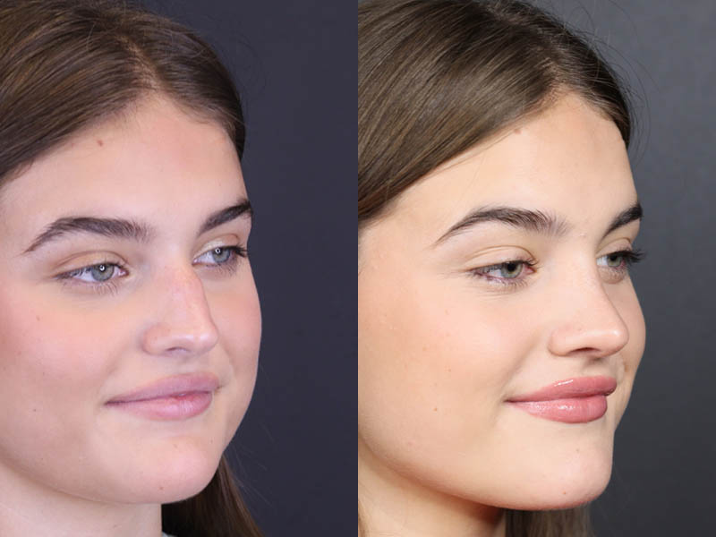 Rhinoplasty case #8366