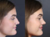 Rhinoplasty case #8366 slider thumbnail