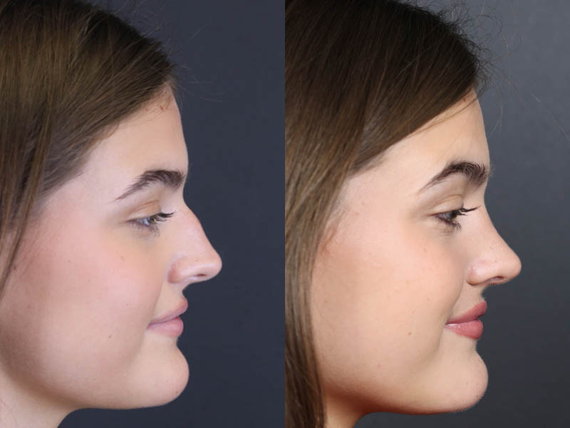 Rhinoplasty case #8366