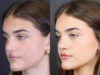 Rhinoplasty case #8366 slider thumbnail