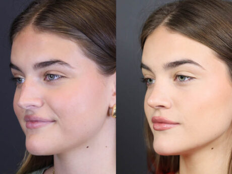 Rhinoplasty case #8366