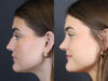 Rhinoplasty case #8366 slider thumbnail