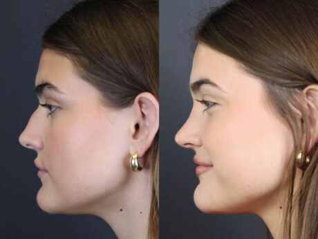 Rhinoplasty case #8366