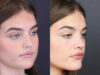 Rhinoplasty case #8366 slider thumbnail