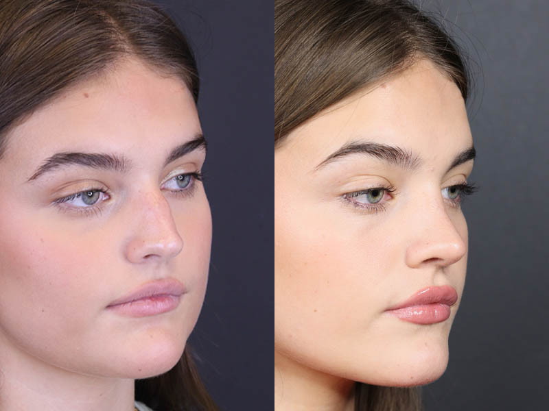 Rhinoplasty case #8366