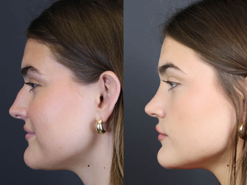Rhinoplasty case #8366