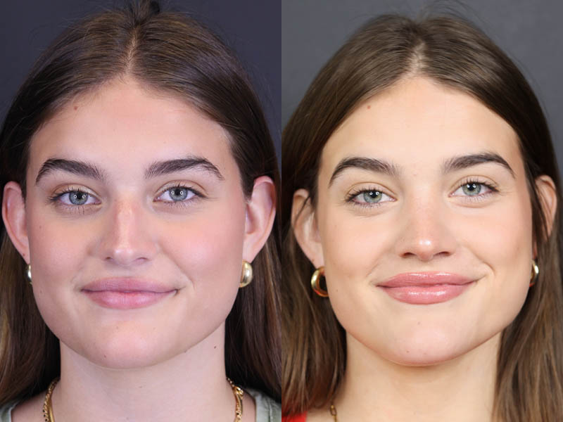 Rhinoplasty case #8366