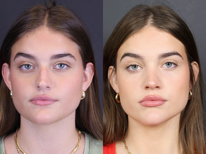 Rhinoplasty case #8366