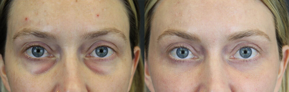 Blepharoplasty case #8411