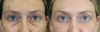 Blepharoplasty case #8411 slider thumbnail