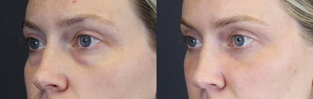 Blepharoplasty case #8411