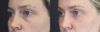 Blepharoplasty case #8411 slider thumbnail