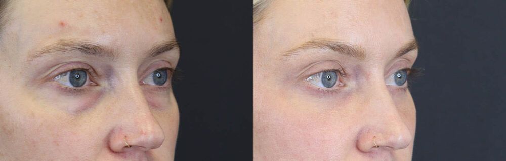 Blepharoplasty case #8411