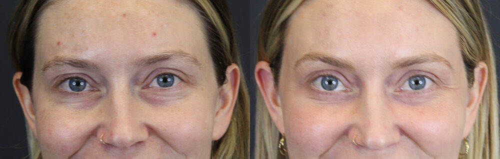 Blepharoplasty case #8411
