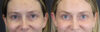 Blepharoplasty case #8411 slider thumbnail
