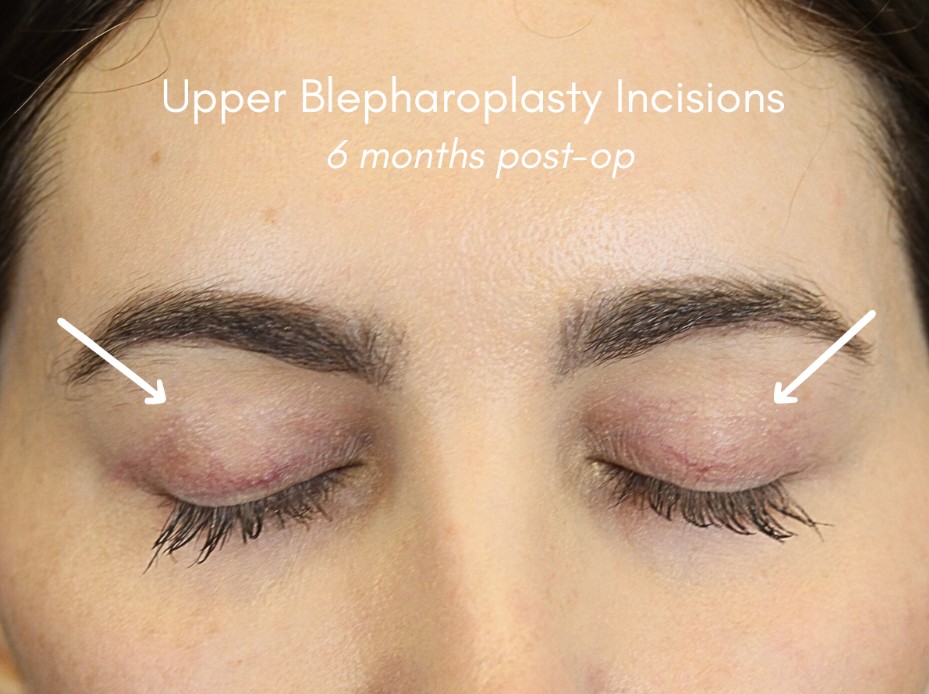 Upper Blepharoplasty Incisions 6 months post-op.