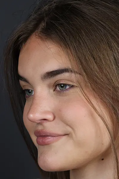 Rhinoplasty case #8366