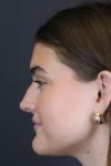 Rhinoplasty case #8366