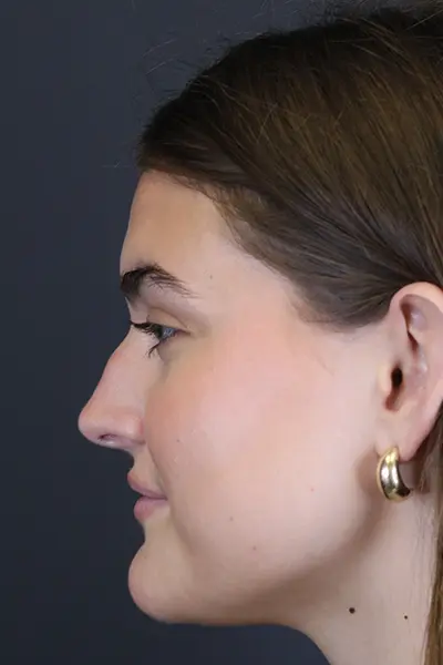 Rhinoplasty case #8366