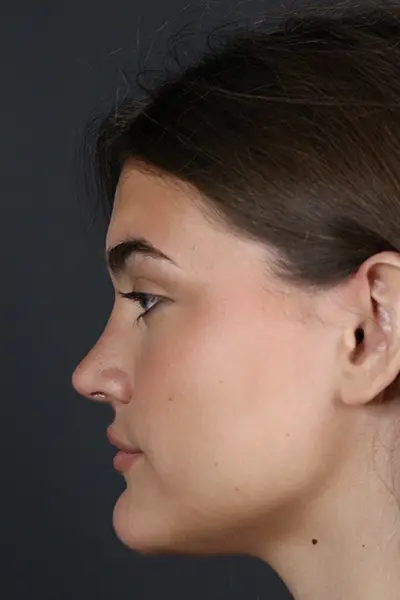 Rhinoplasty case #8366