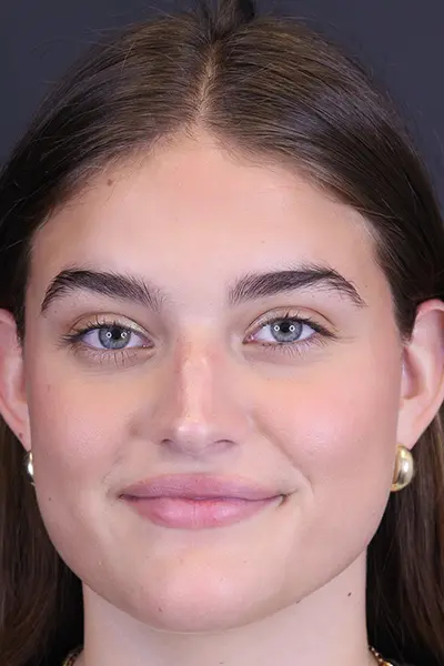 Rhinoplasty case #8366