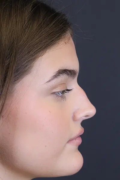 Rhinoplasty case #8366