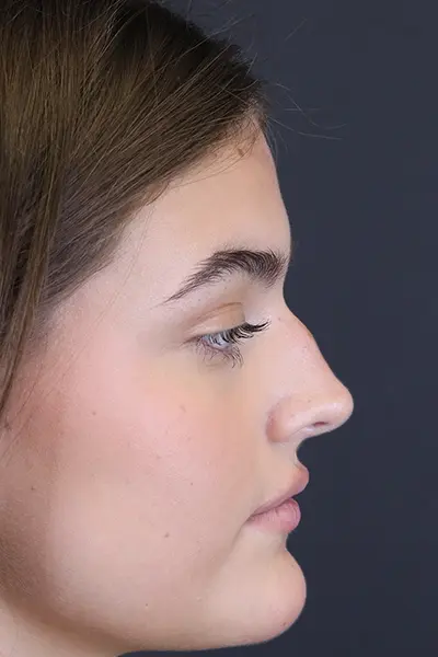Rhinoplasty case #8366